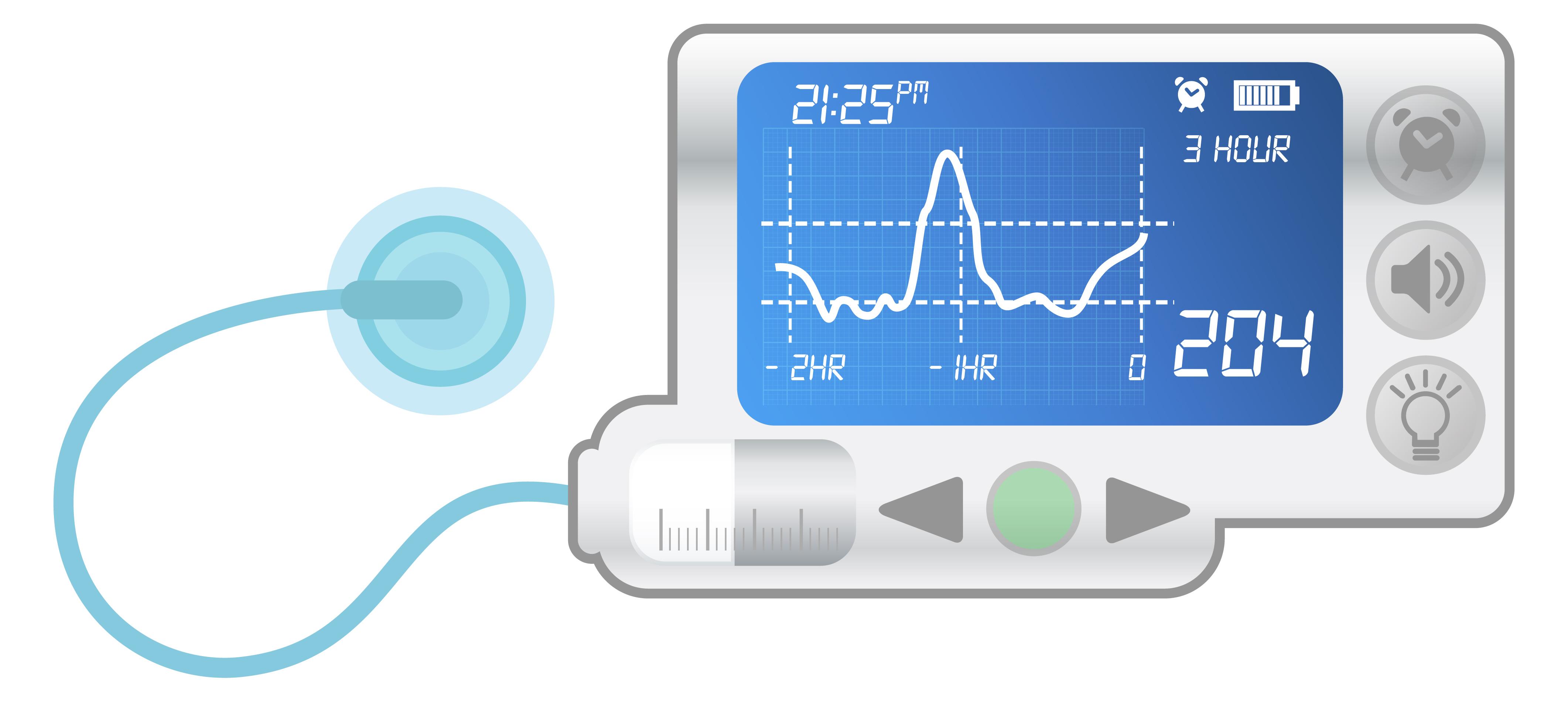 Инсулиновая помпа картинки
